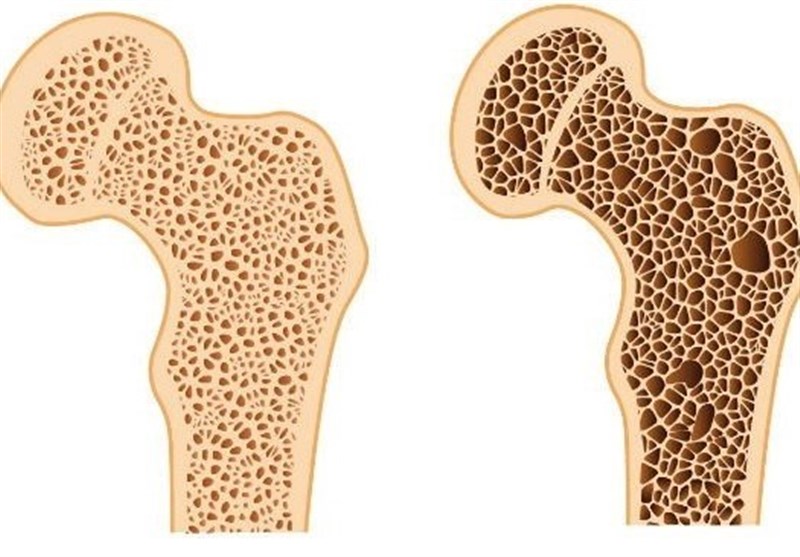 بهترین روش تشخیص پوکی استخوان/ دلایل ابتلا به بیماری
