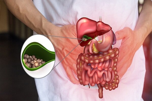 علل ایجاد سنگ کیسه صفرا؛ چه زمانی به جراحی نیاز داریم؟